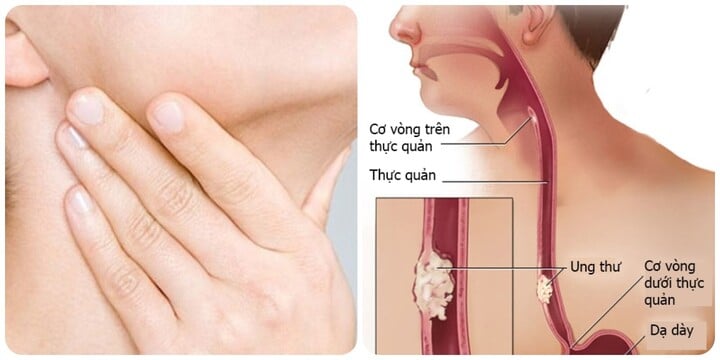 Những dấu hiệu ung thư thực quản giai đoạn đầu - Ảnh 1.