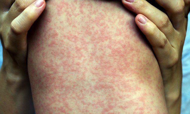 measles-rash-1742651947700912307830-1742689803518-17426898037191662801272.jpg