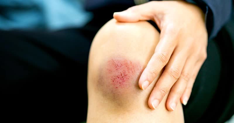 Hình ảnh một người đang kiểm tra vết bầm trên da
