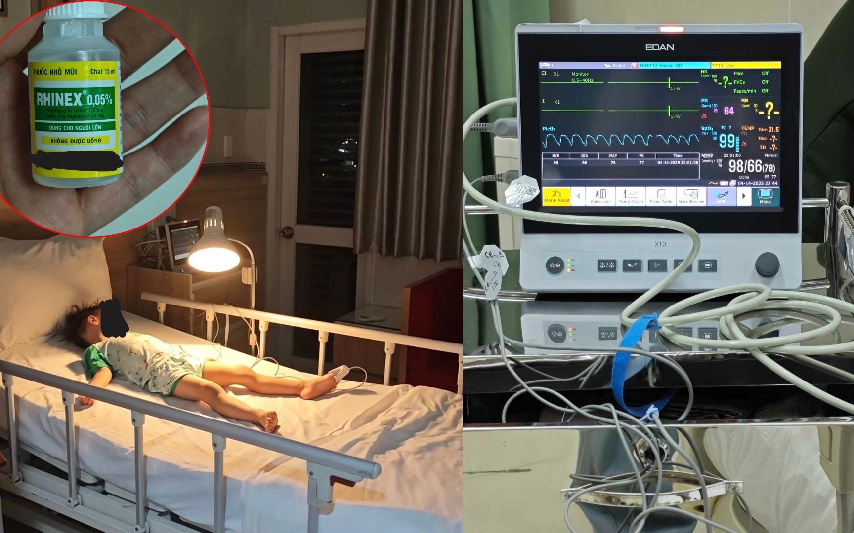 D&ugrave;ng thuốc nhỏ mũi người lớn, b&eacute; trai tăng huyết &aacute;p nguy kịch - Ảnh 2.