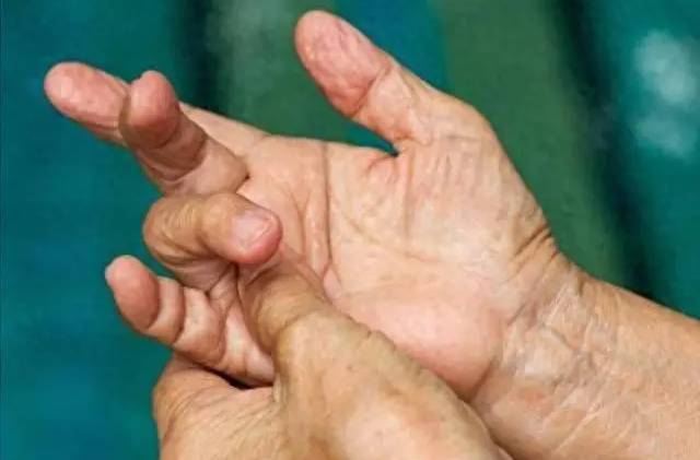 4 thay đổi ở ngón tay có thể là dấu hiệu ung thư phổi, hãy đi khám ngay! - Ảnh 6. 4 thay đổi ở ngón tay có thể là dấu hiệu ung thư phổi, hãy đi khám ngay! - Ảnh 6.
