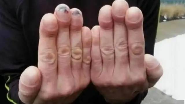 4 thay đổi ở ngón tay có thể là dấu hiệu ung thư phổi, hãy đi khám ngay! - Ảnh 2. 4 thay đổi ở ngón tay có thể là dấu hiệu ung thư phổi, hãy đi khám ngay! - Ảnh 2.