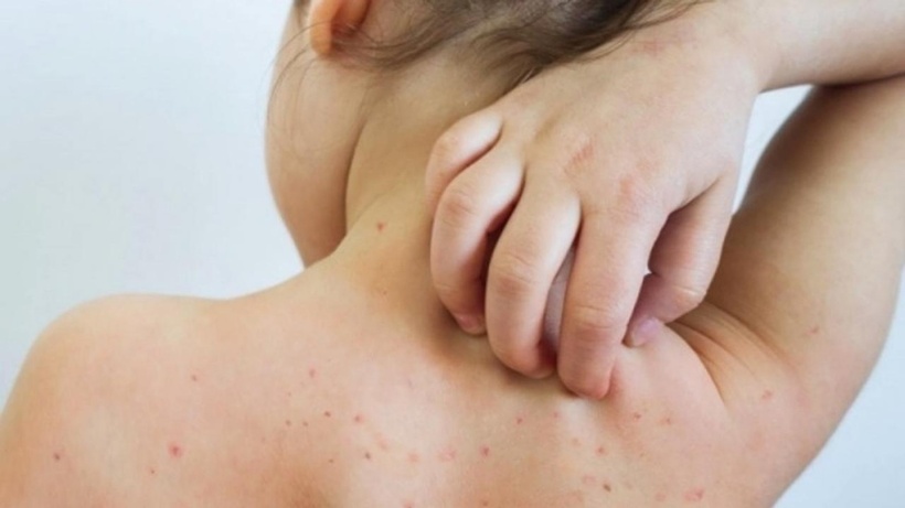 Một ca rubella vừa phát hiện: Bố mẹ chủ quan, trẻ lãnh hậu quả - Ảnh 1. Một ca rubella vừa phát hiện: Bố mẹ chủ quan, trẻ lãnh hậu quả - Ảnh 1.