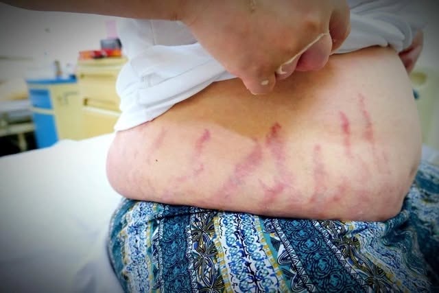 "Con tôi chỉ bị viêm mũi dị ứng thôi mà...": Người mẹ khóc nấc không ngờ thói quen xịt mũi lại khiến con bị suy tuyến thượng thận - Ảnh 2. "Con tôi chỉ bị viêm mũi dị ứng thôi mà...": Người mẹ khóc nấc không ngờ thói quen xịt mũi lại khiến con bị suy tuyến thượng thận - Ảnh 2.
