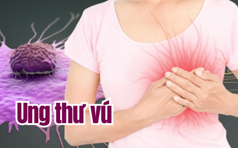 ung-thu-vu-ava-17469580794501847144869.jpg
