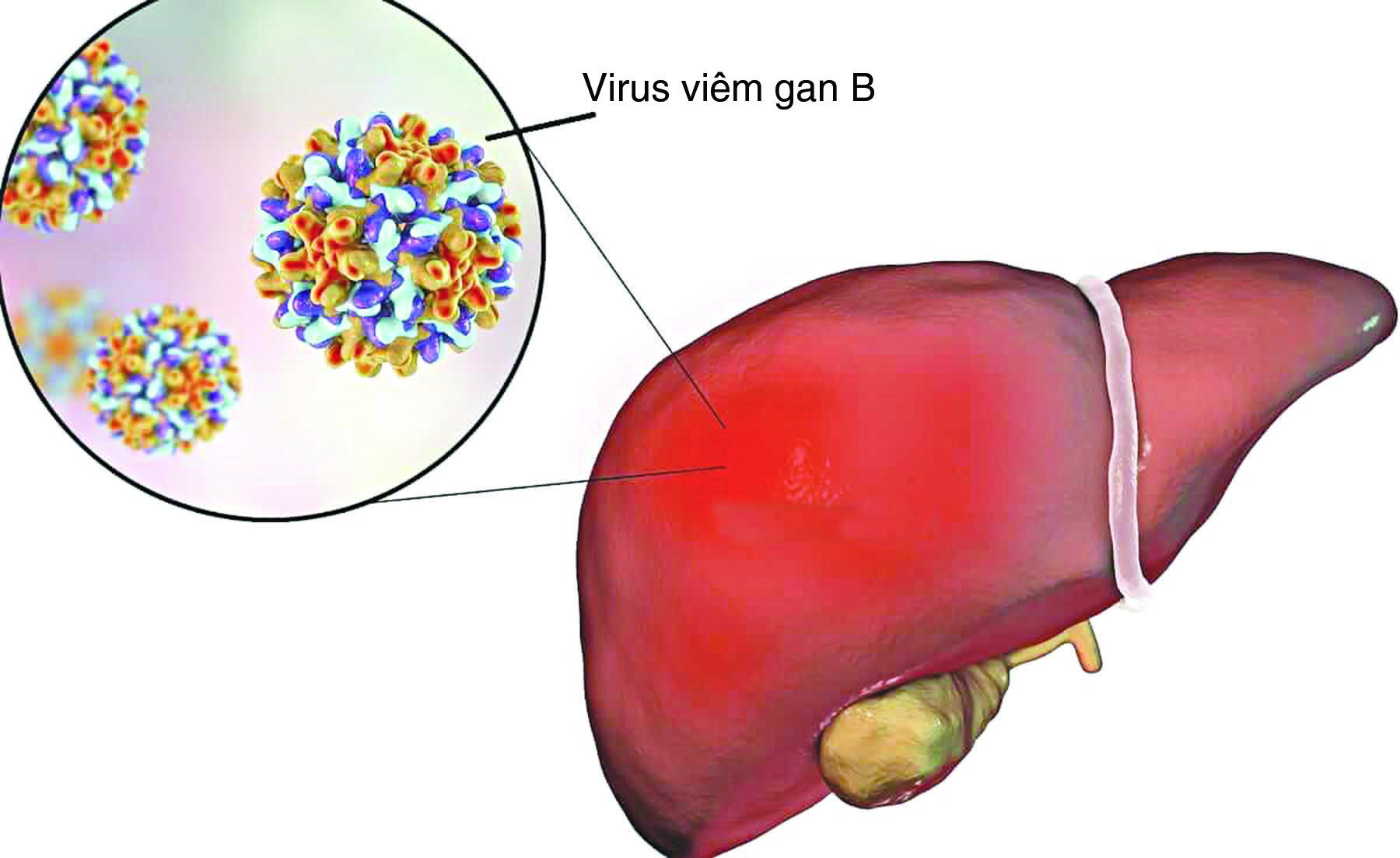 Căn bệnh lây truyền mà Vũ Cát Tường đang mang, phải uống thuốc hàng ngày, 3 tháng đi tầm soát ung thư 1 lần nguy hiểm thế nào?- Ảnh 2. Căn bệnh lây truyền mà Vũ Cát Tường đang mang, phải uống thuốc hàng ngày, 3 tháng đi tầm soát ung thư 1 lần nguy hiểm thế nào?- Ảnh 2.