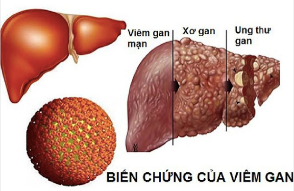 Căn bệnh lây truyền mà Vũ Cát Tường đang mang, phải uống thuốc hàng ngày, 3 tháng đi tầm soát ung thư 1 lần nguy hiểm thế nào?- Ảnh 3. Căn bệnh lây truyền mà Vũ Cát Tường đang mang, phải uống thuốc hàng ngày, 3 tháng đi tầm soát ung thư 1 lần nguy hiểm thế nào?- Ảnh 3.