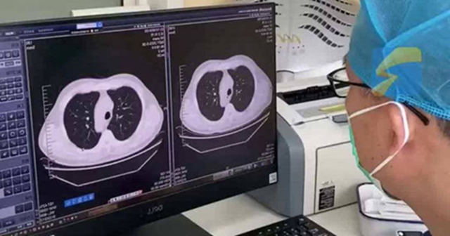 Cảm lạnh và ho, phổi trái của nam sinh đột nhiên "biến mất": Bác sĩ tiết lộ nguyên nhân nhiều người phải cẩn thận - Ảnh 1. Cảm lạnh và ho, phổi trái của nam sinh đột nhiên "biến mất": Bác sĩ tiết lộ nguyên nhân nhiều người phải cẩn thận - Ảnh 1.