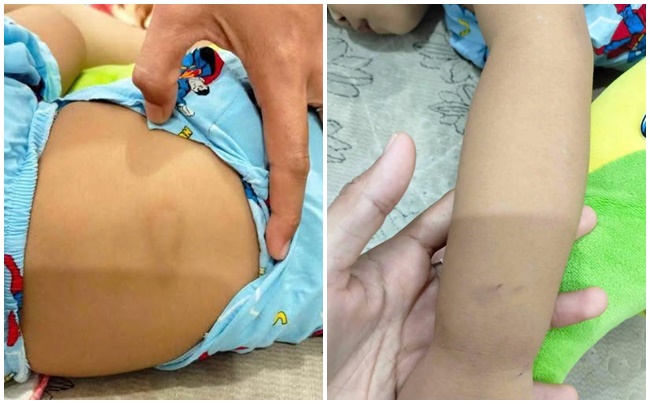 Bé gái 2 tuổi nghi bị bạo hành tại điểm giữ trẻ, câu trả lời không thỏa đáng - Ảnh 1. Bé gái 2 tuổi nghi bị bạo hành tại điểm giữ trẻ, câu trả lời không thỏa đáng - Ảnh 1.
