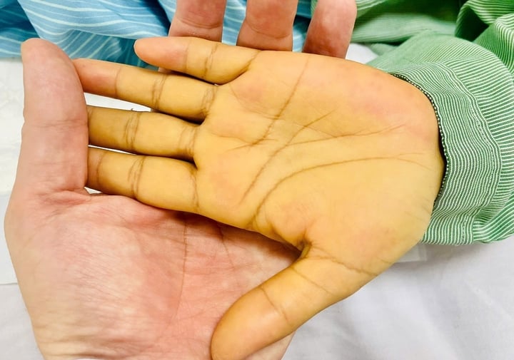 5 dấu hiệu nhận biết sớm ung thư gan không nên bỏ qua - Ảnh 1. 5 dấu hiệu nhận biết sớm ung thư gan không nên bỏ qua - Ảnh 1.