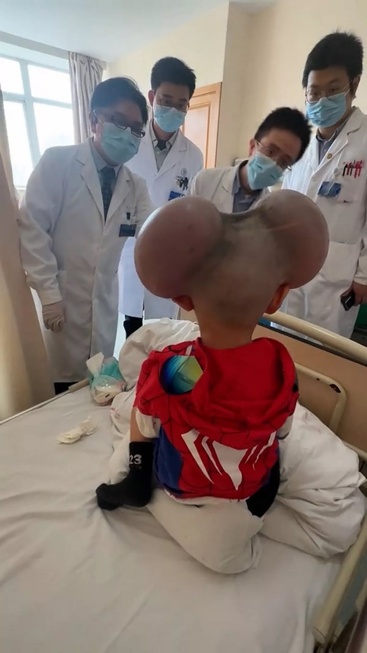 Nốt ruồi khổng lồ phủ kín hộp sọ khiến cậu bé có ngoại hình giống chuột Mickey - Ảnh 2. Nốt ruồi khổng lồ phủ kín hộp sọ khiến cậu bé có ngoại hình giống chuột Mickey - Ảnh 2.