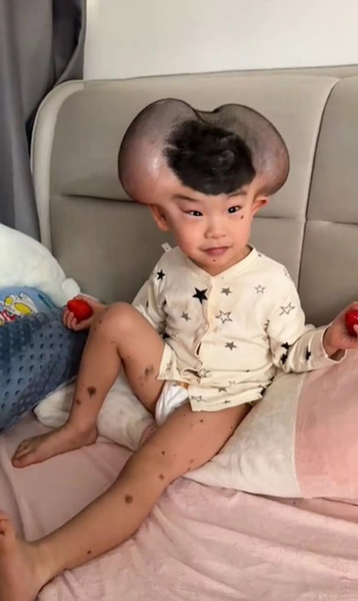 Nốt ruồi khổng lồ phủ kín hộp sọ khiến cậu bé có ngoại hình giống chuột Mickey - Ảnh 1. Nốt ruồi khổng lồ phủ kín hộp sọ khiến cậu bé có ngoại hình giống chuột Mickey - Ảnh 1.