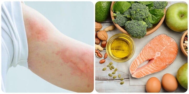 Dấu hiệu thiếu Omega-3 bạn không nên chủ quan - Ảnh 2. Dấu hiệu thiếu Omega-3 bạn không nên chủ quan - Ảnh 2.