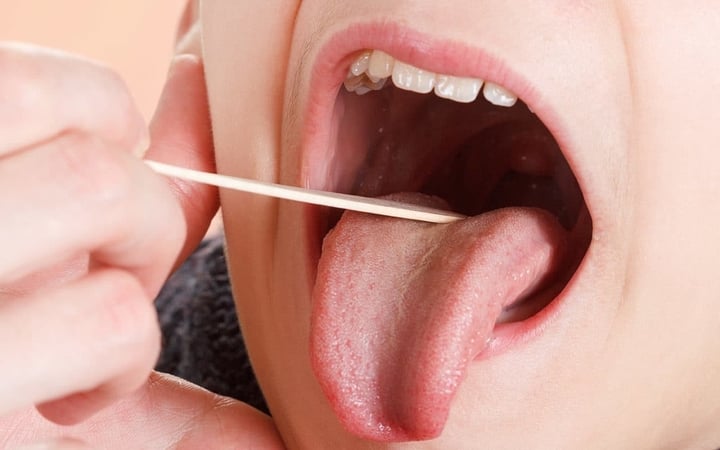 Loét miệng ba tháng không lành, đến viện khám phát hiện ung thư - Ảnh 2. Loét miệng ba tháng không lành, đến viện khám phát hiện ung thư - Ảnh 2.