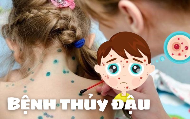 Infographic: Thủy đậu - căn bệnh tưởng nhẹ nhưng không thể xem thường