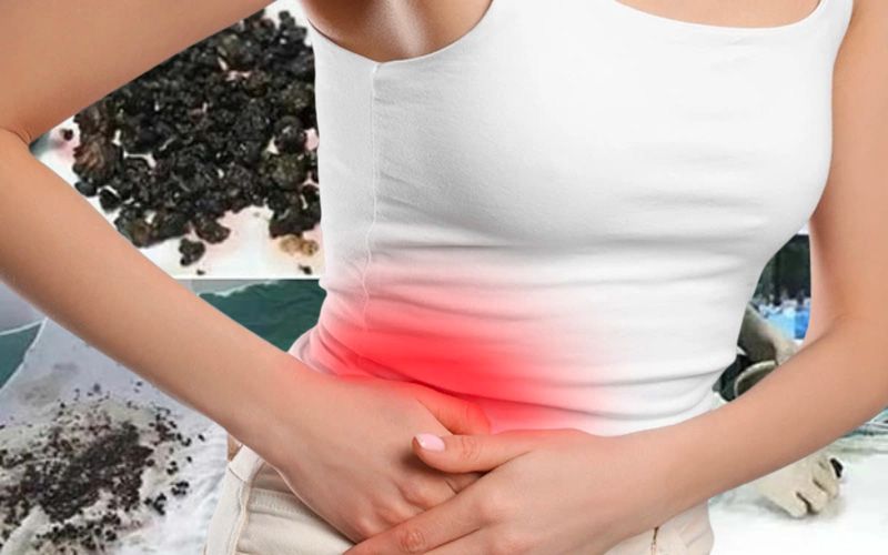 Sốc khi lấy ra 95 viên sỏi từ cơ thể người phụ nữ 40 tuổi, bác sĩ nhắc 