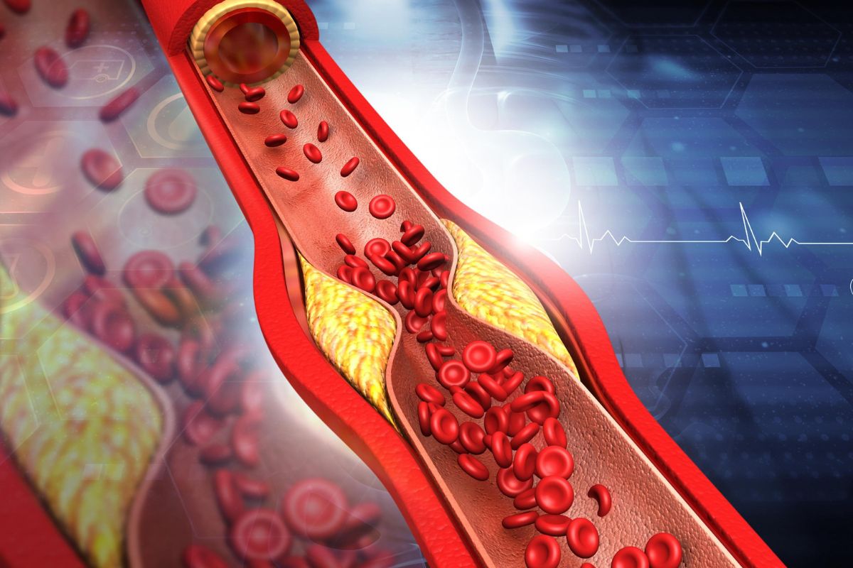 1 triệu chứng xảy ra trên giường có thể báo hiệu động mạch tắc nghẽn, cholesterol cao ngất ngưởng - Ảnh 1. 1 triệu chứng xảy ra trên giường có thể báo hiệu động mạch tắc nghẽn, cholesterol cao ngất ngưởng - Ảnh 1.