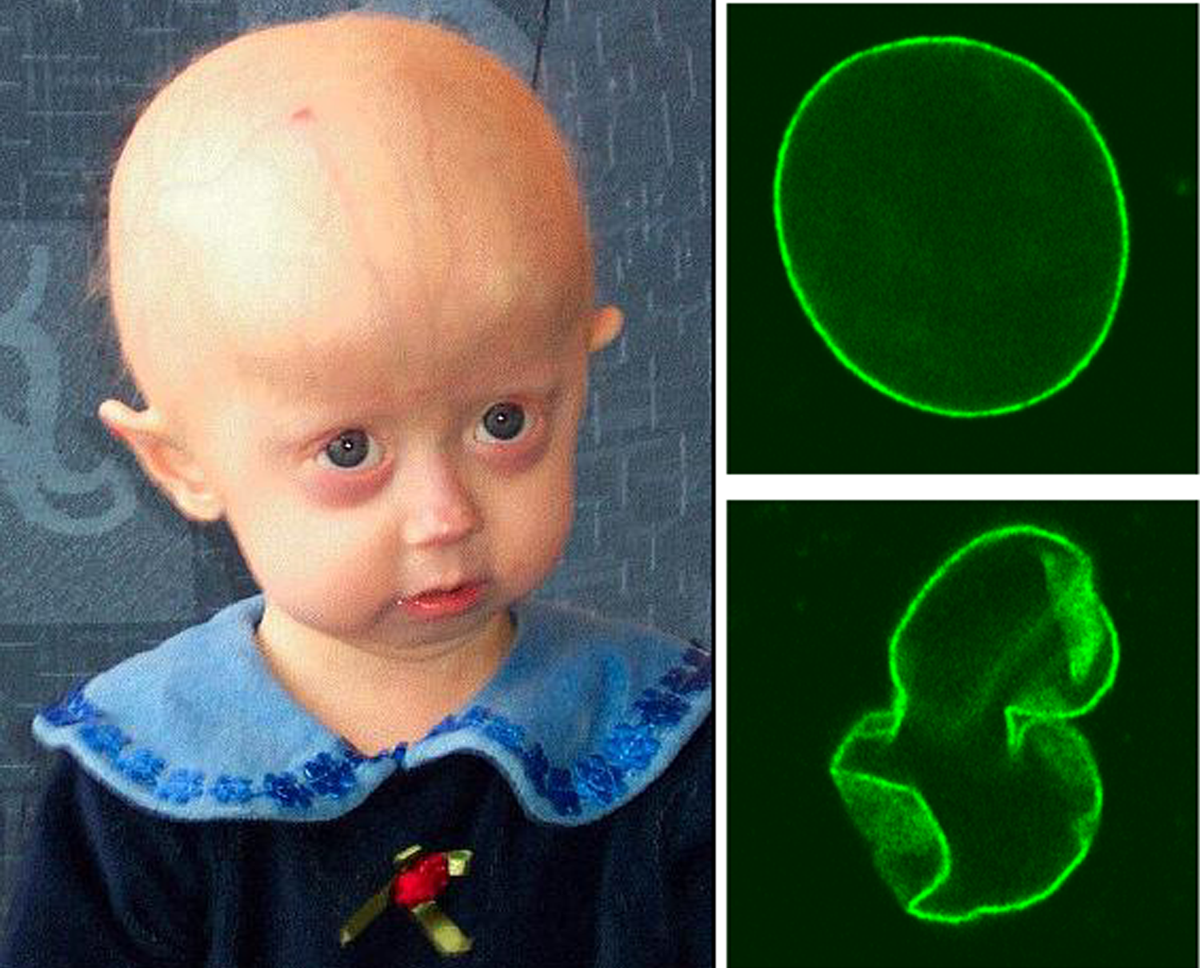 hutchinson-gilfordprogeriasyndrome-1748705437592950740490.png