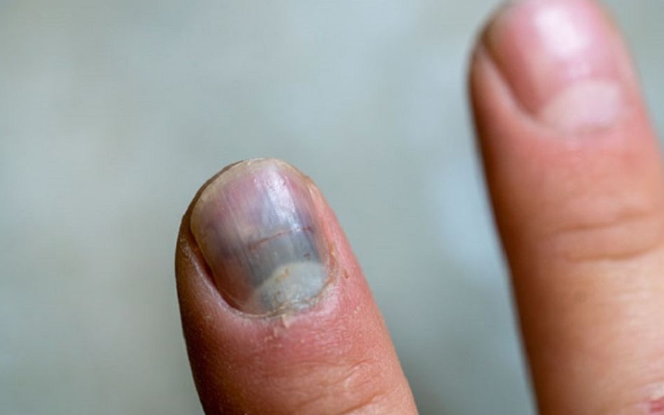 Giật mình: 5 dấu hiệu ở bàn tay cảnh báo phổi đang gặp nguy hiểm