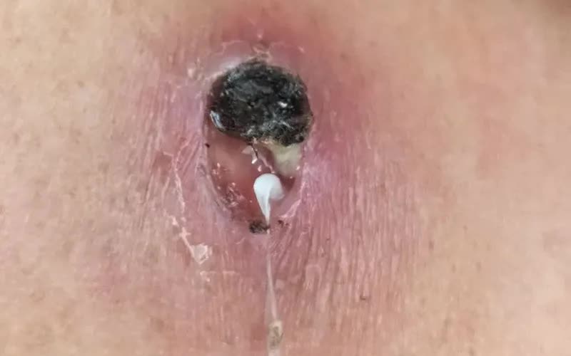 Phát hiện một ca mắc giun rồng tại Phú Thọ - Ảnh 1. Phát hiện một ca mắc giun rồng tại Phú Thọ - Ảnh 1.