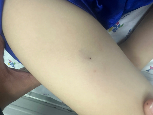 Bé trai sốc phản vệ nguy kịch vì vết đốt của ong ruồi - Ảnh 1. Bé trai sốc phản vệ nguy kịch vì vết đốt của ong ruồi - Ảnh 1.