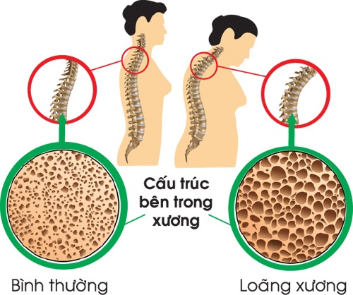 Phụ nữ sau mãn kinh cẩn trọng với "sát thủ thầm lặng" này: Không nhìn thấy bằng mắt thường, không dấu hiệu cảnh báo - Ảnh 3. Phụ nữ sau mãn kinh cẩn trọng với "sát thủ thầm lặng" này: Không nhìn thấy bằng mắt thường, không dấu hiệu cảnh báo - Ảnh 3.