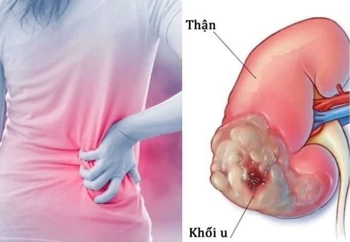 ung-thu-than-1-05553787-1749514369545-17495143697451942928297.jpg