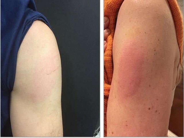 Tiêm vắc xin HPV có phản ứng phụ nào không, khi nào cần gặp bác sĩ? - Ảnh 1. Tiêm vắc xin HPV có phản ứng phụ nào không, khi nào cần gặp bác sĩ? - Ảnh 1.