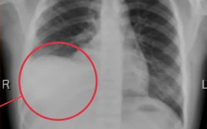 Cảnh báo tràn dịch màng phổi ở trẻ: Nguy hiểm nếu chậm phát hiện - Ảnh 1. Cảnh báo tràn dịch màng phổi ở trẻ: Nguy hiểm nếu chậm phát hiện - Ảnh 1.