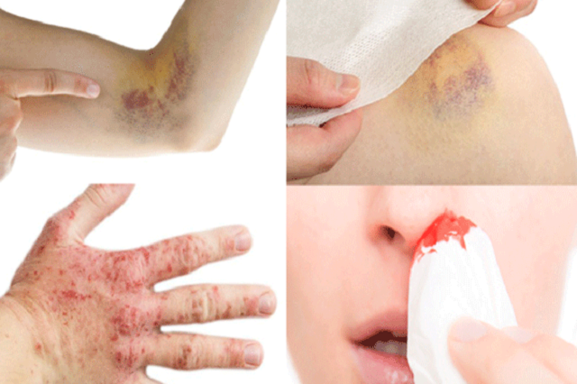 Khoảnh khắc cô gái 23 tuổi bị ung thư máu ngồi khóc ở hành lang bệnh viện khiến nhiều người đau lòng: Đừng bỏ qua những dấu hiệu bệnh- Ảnh 3. Khoảnh khắc cô gái 23 tuổi bị ung thư máu ngồi khóc ở hành lang bệnh viện khiến nhiều người đau lòng: Đừng bỏ qua những dấu hiệu bệnh- Ảnh 3.