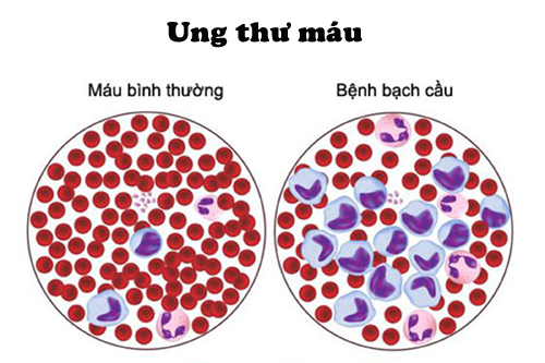 Khoảnh khắc cô gái 23 tuổi bị ung thư máu ngồi khóc ở hành lang bệnh viện khiến nhiều người đau lòng: Đừng bỏ qua những dấu hiệu bệnh- Ảnh 2. Khoảnh khắc cô gái 23 tuổi bị ung thư máu ngồi khóc ở hành lang bệnh viện khiến nhiều người đau lòng: Đừng bỏ qua những dấu hiệu bệnh- Ảnh 2.