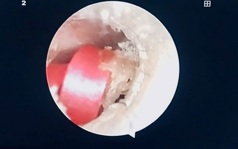 Bé gái suýt thủng màng nhĩ vì dị vật là sợi dây buộc tóc