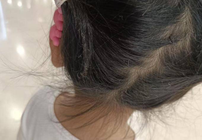 Bóng bay phát nổ khiến bé gái bị cháy sém tóc, người mẹ đăng đàn cảnh báo phụ huynh không nên mua loại bóng này- Ảnh 2. Bóng bay phát nổ khiến bé gái bị cháy sém tóc, người mẹ đăng đàn cảnh báo phụ huynh không nên mua loại bóng này- Ảnh 2.