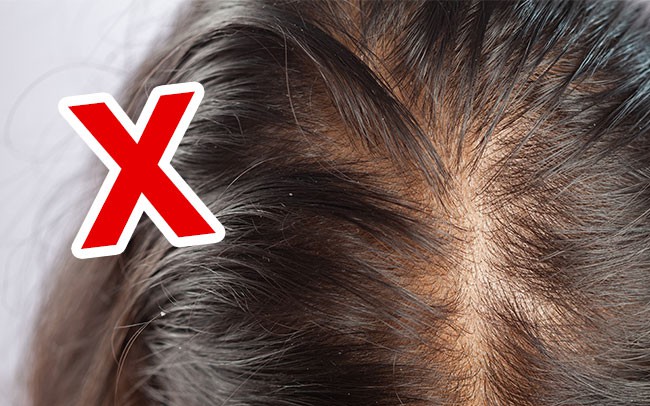 2 sai lầm khiến chị em rụng tóc và gàu dai dẳng, chuyên gia chỉ cách khắc phục