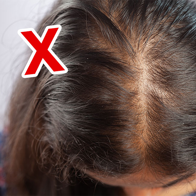 2 sai lầm khiến chị em rụng tóc và gàu dai dẳng, chuyên gia chỉ cách khắc phục - Ảnh 1. 2 sai lầm khiến chị em rụng tóc và gàu dai dẳng, chuyên gia chỉ cách khắc phục - Ảnh 1.