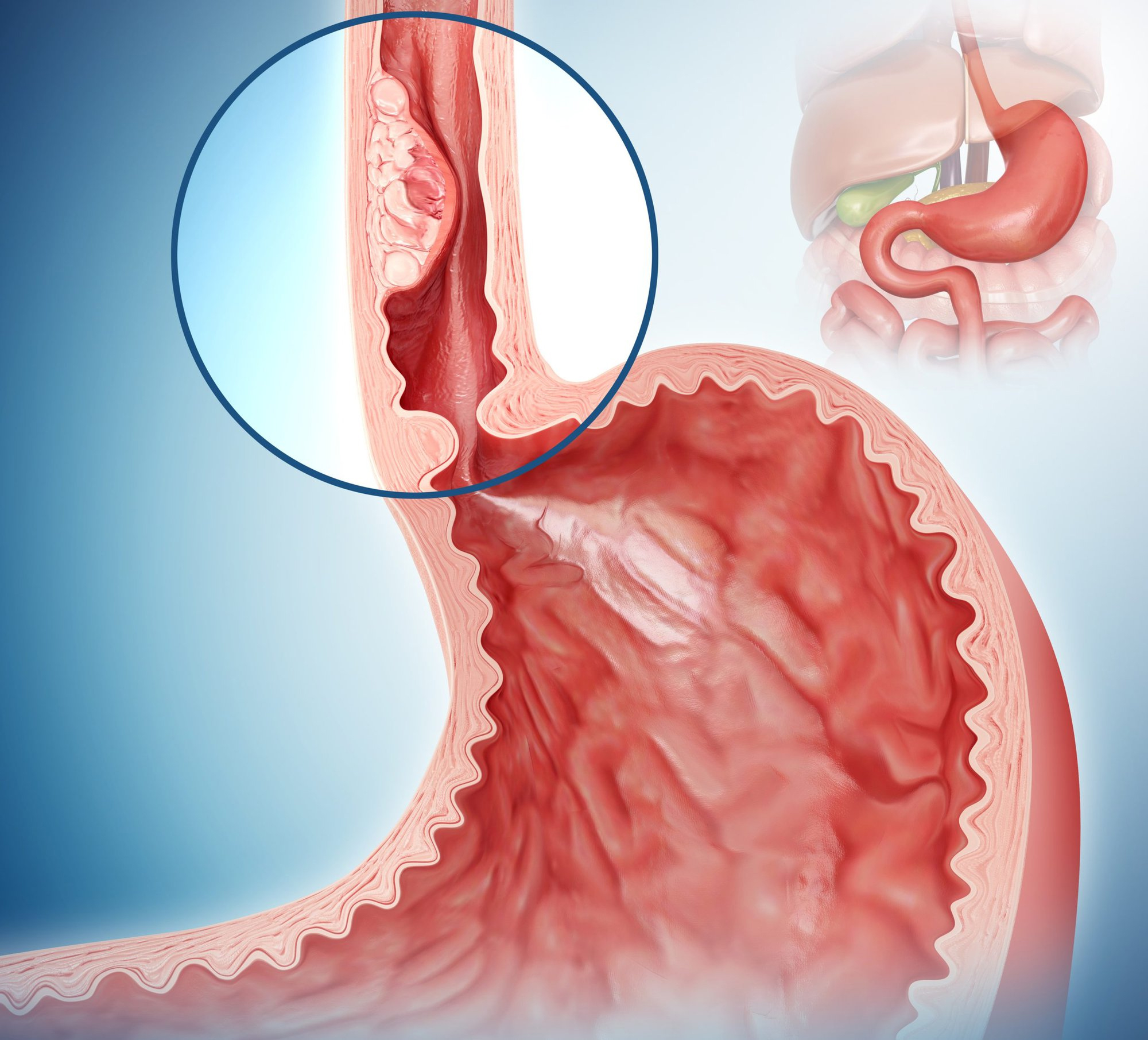 Thói quen ăn uống tưởng chừng vô hại âm thầm phá hủy tế bào, gia tăng nguy cơ ung thư thực quản- Ảnh 1.