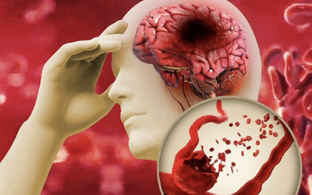Nhiều người trẻ bị đột quỵ, có cần tầm soát nguy cơ?