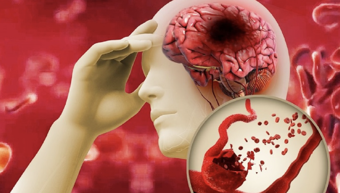 Nhiều người trẻ bị đột quỵ, có cần tầm soát nguy cơ? - Ảnh 1. Thanh niên bị đột quỵ, vậy có cần tầm soát nguy cơ? - Ảnh 1.