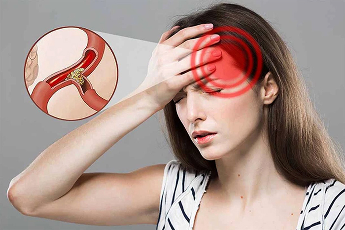 Ngày càng nhiều người bị nhồi máu não: Cảnh giác 3 loại gia vị là "thủ phạm", ghi nhớ quy tắc "một nhìn, hai nghe, ba cảm nhận" để phát hiện bệnh- Ảnh 4. Ngày càng nhiều người bị nhồi máu não: Cảnh giác 3 loại gia vị là "thủ phạm", ghi nhớ quy tắc "một nhìn, hai nghe, ba cảm nhận" để phát hiện bệnh- Ảnh 4.