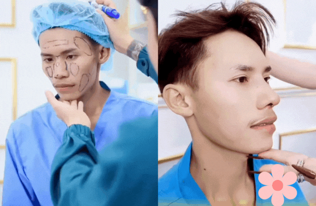 Chàng trai hot nhất Nam vương Campuchia đạt kết quả không tưởng sau 2 tháng sửa hết mặt tại Việt Nam- Ảnh 4. Chàng trai hot nhất Nam vương Campuchia đạt kết quả không tưởng sau 2 tháng sửa hết mặt tại Việt Nam- Ảnh 4.