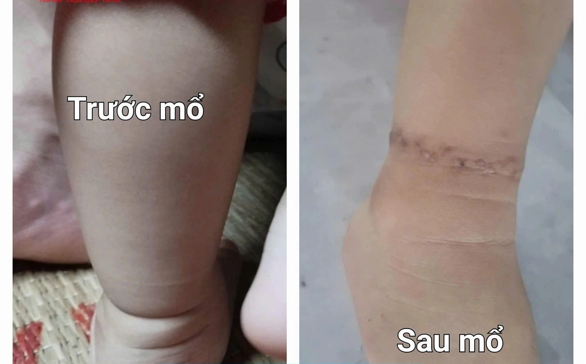 Thấy bàn tay bụ bẫm của con có 1 "chi tiết lạ", mẹ Việt lên mạng mới biết con có "dấu hiệu dị tật", cần đến khám bác sĩ Nhi gấp - Ảnh 2. Thấy bàn tay bụ bẫm của con có 1 "chi tiết lạ", mẹ Việt lên mạng mới biết con có "dấu hiệu dị tật", cần đến khám bác sĩ Nhi gấp - Ảnh 2.