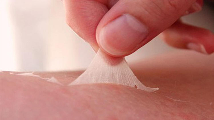 Dùng axit tẩy trắng da, cô gái bị bỏng toàn thân - Ảnh 1. Dùng axit tẩy trắng da, cô gái bị bỏng toàn thân - Ảnh 1.