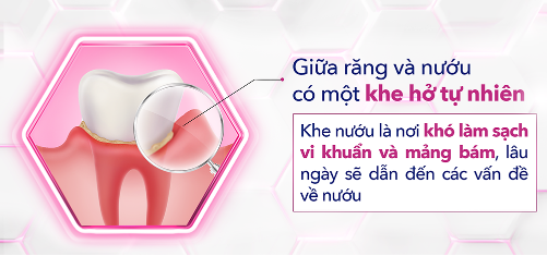 Cảnh báo: Nướu yếu làm răng hư hại – Chăm sóc ngay trước khi quá muộn - Ảnh 2. Cảnh báo: Nướu yếu làm răng hư hại – Chăm sóc ngay trước khi quá muộn - Ảnh 2.