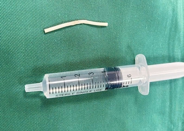 Que tr&aacute;nh thai &ldquo;đi lạc&rdquo; suốt 4 th&aacute;ng trong bắp tay- Ảnh 1.