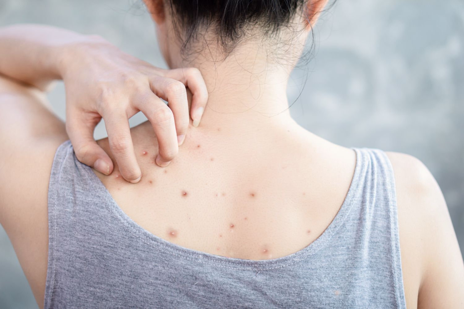 Mọc mụn ở lưng có phải do nóng gan? - Ảnh 1. Mọc mụn ở lưng có phải do nóng gan? - Ảnh 1.
