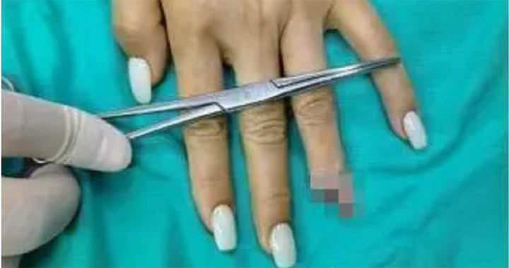 Bị gãy ngón tay do kẹp cửa mà không biết chỉ vì sơn móng quá dày - Ảnh 3. Bị gãy ngón tay do kẹp cửa mà không biết chỉ vì sơn móng quá dày - Ảnh 3.