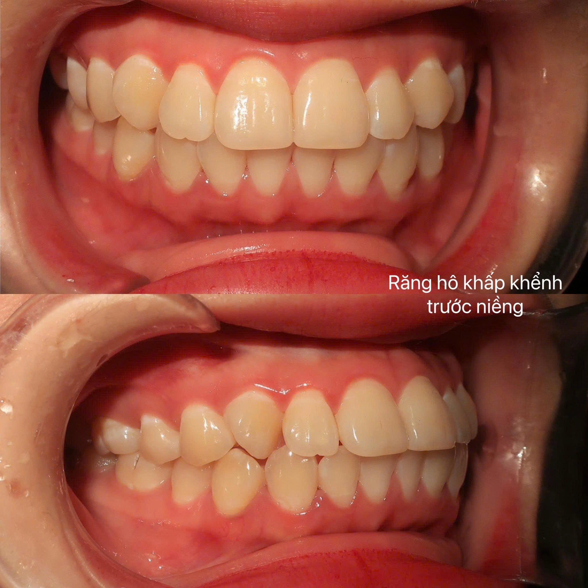 Niềng răng sau tuổi 30: Bác sĩ nói trễ nhưng không hề muộn để đẹp và khỏe- Ảnh 3. Niềng răng sau tuổi 30: Bác sĩ nói trễ nhưng không hề muộn để đẹp và khỏe- Ảnh 3.
