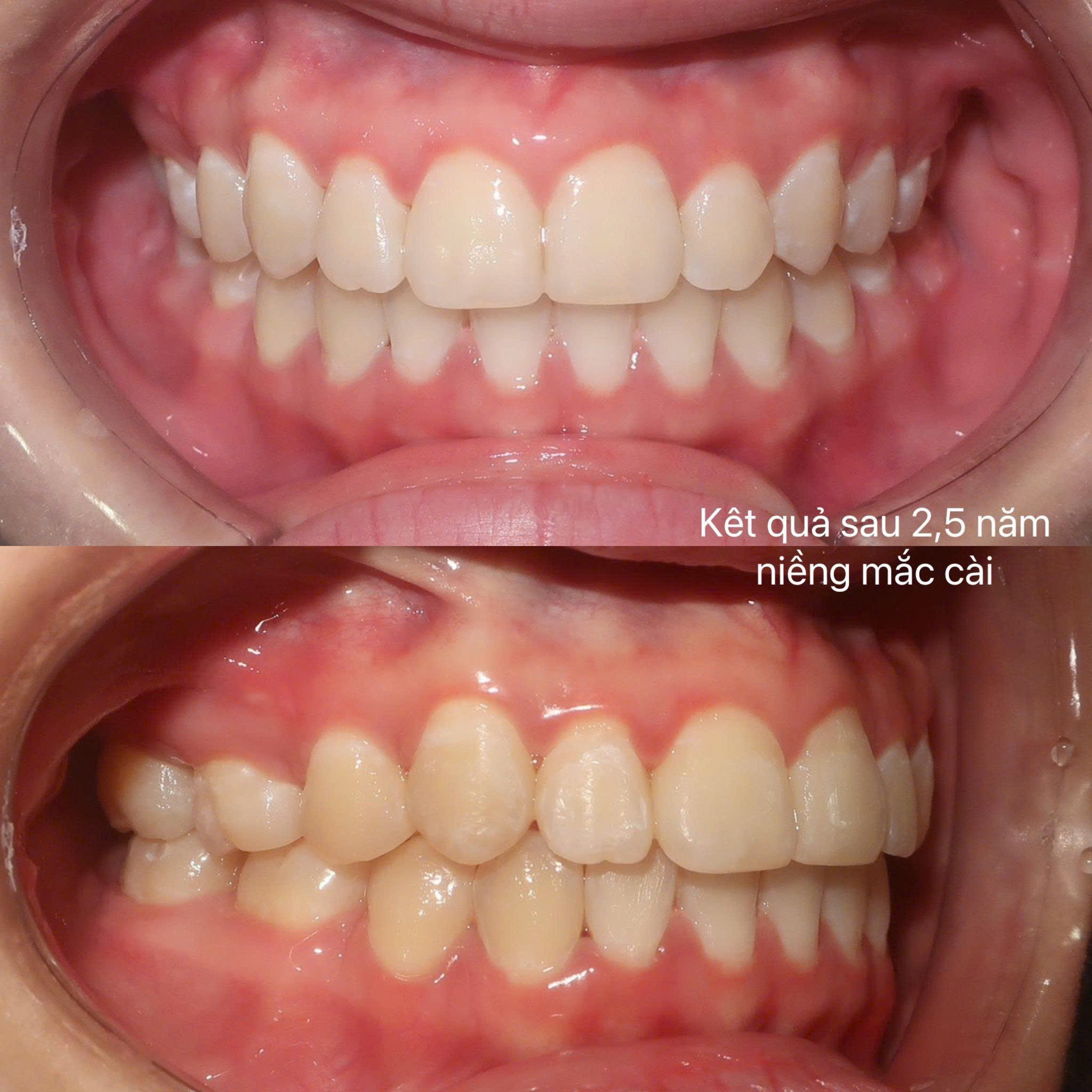Niềng răng sau tuổi 30: Bác sĩ nói trễ nhưng không hề muộn để đẹp và khỏe- Ảnh 4. Niềng răng sau tuổi 30: Bác sĩ nói trễ nhưng không hề muộn để đẹp và khỏe- Ảnh 4.