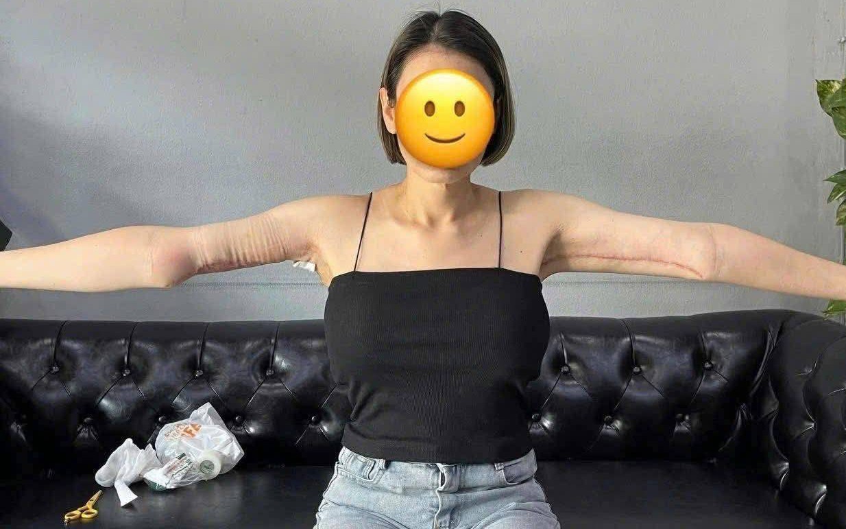 Hình ảnh cánh tay sau hút mỡ khiến ai cũng &quot;bàng hoàng&quot;: Sai 1 ly đi cả sức khỏe!