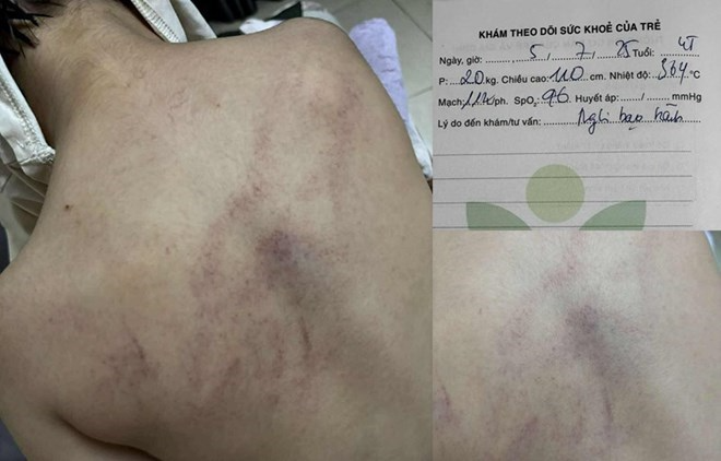 Vụ bé gái 4 tuổi bị đánh tím lưng: Đình chỉ thêm 1 giáo viên - Ảnh 1. Vụ bé gái 4 tuổi bị đánh tím lưng: Đình chỉ thêm 1 giáo viên - Ảnh 1.